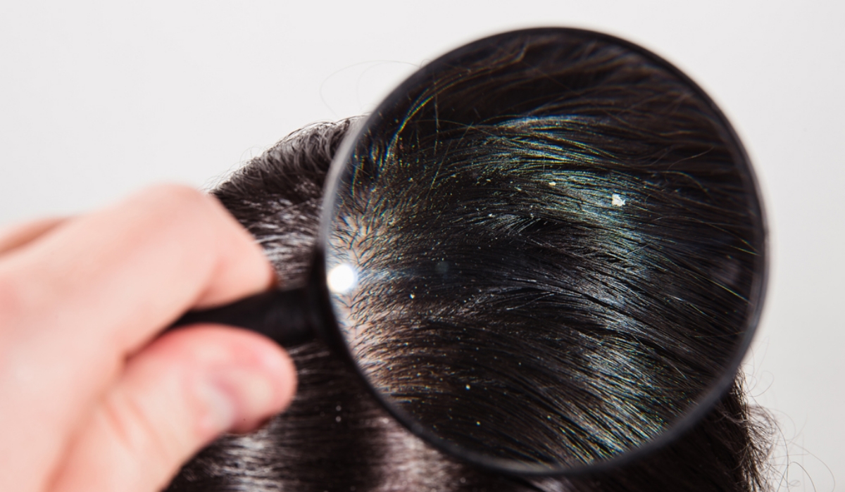 Clientii tai se confrunta cu matreata abundenta? Ce le poti recomanda?