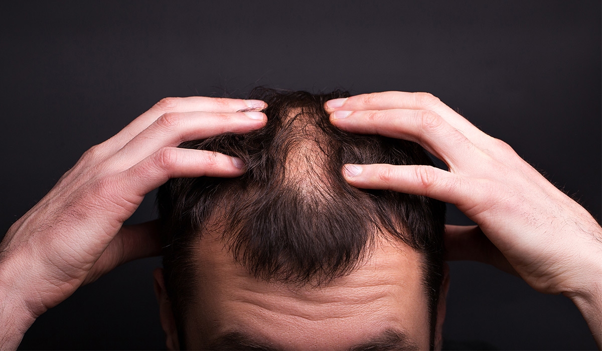 Motivele principale ale caderii parului